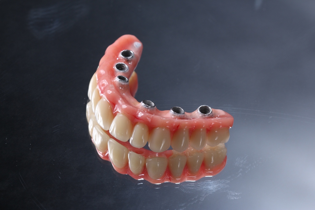 Resultado de imagem para implante dentario